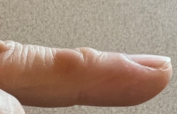 IPhone Injury